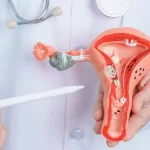 Endometriosis