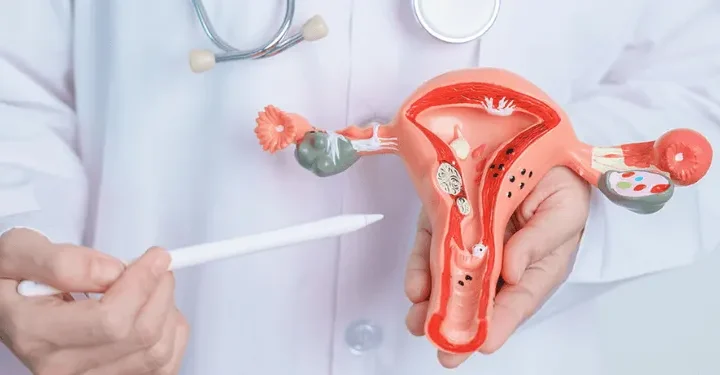 Endometriosis