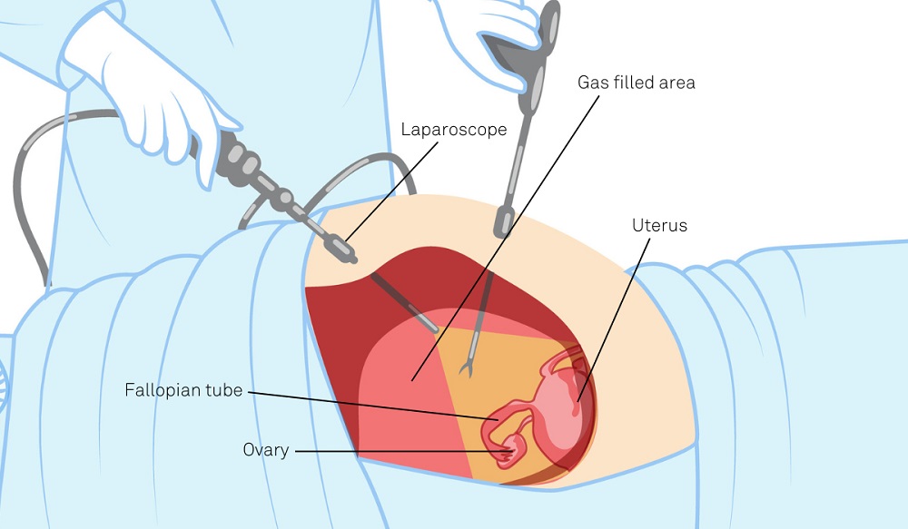 Laparoscopic Surgery in India